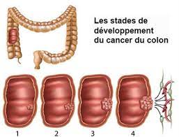 Cancer du côlon-Mars Bleu